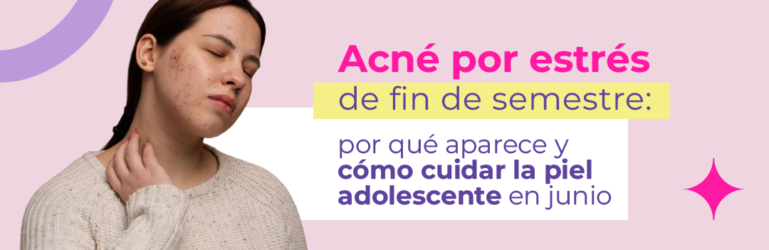 Acné por estrés de fin de semestre: por qué aparece y cómo cuidar la piel adolescente en junio