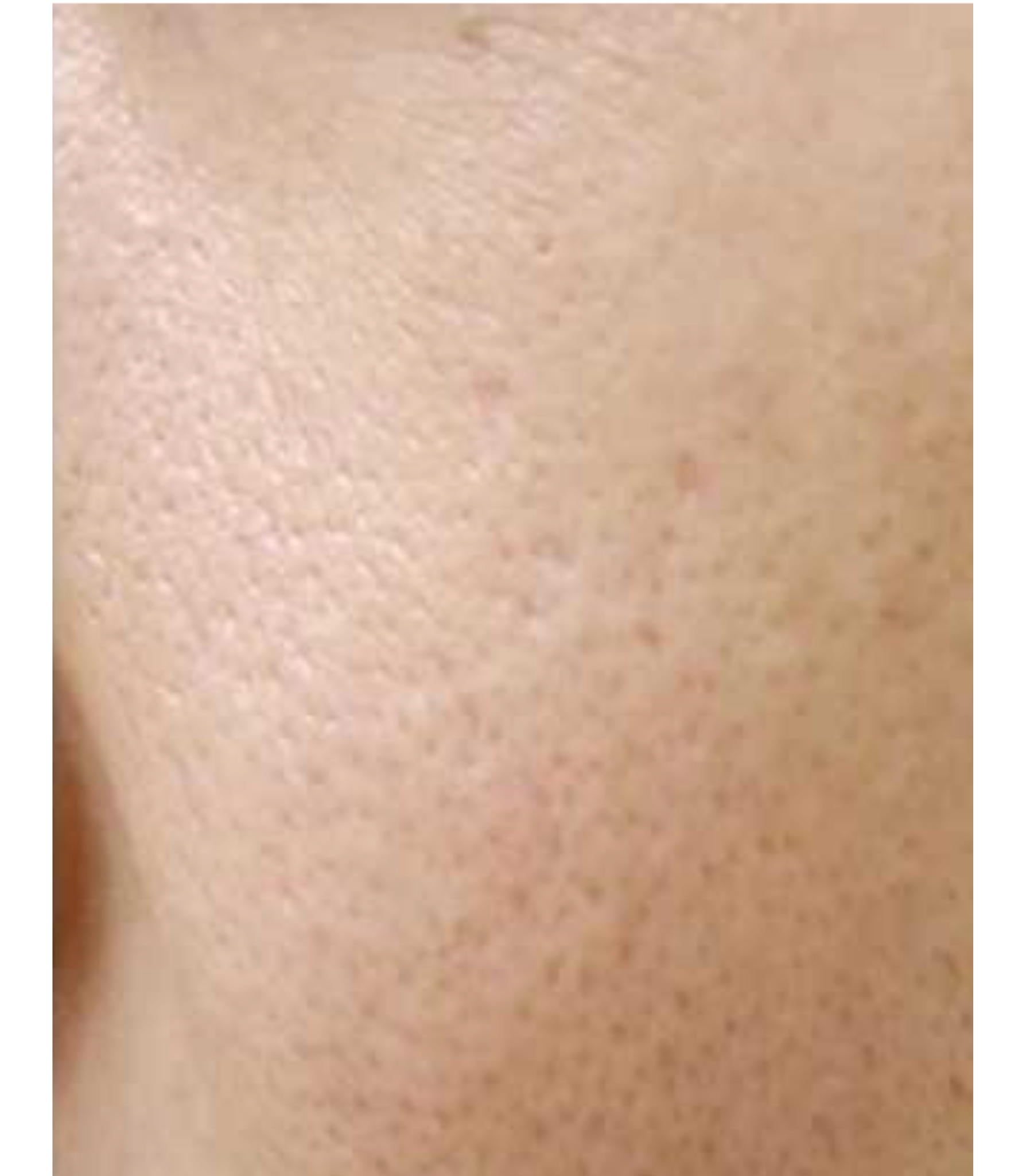 Serúm Antioleosidad