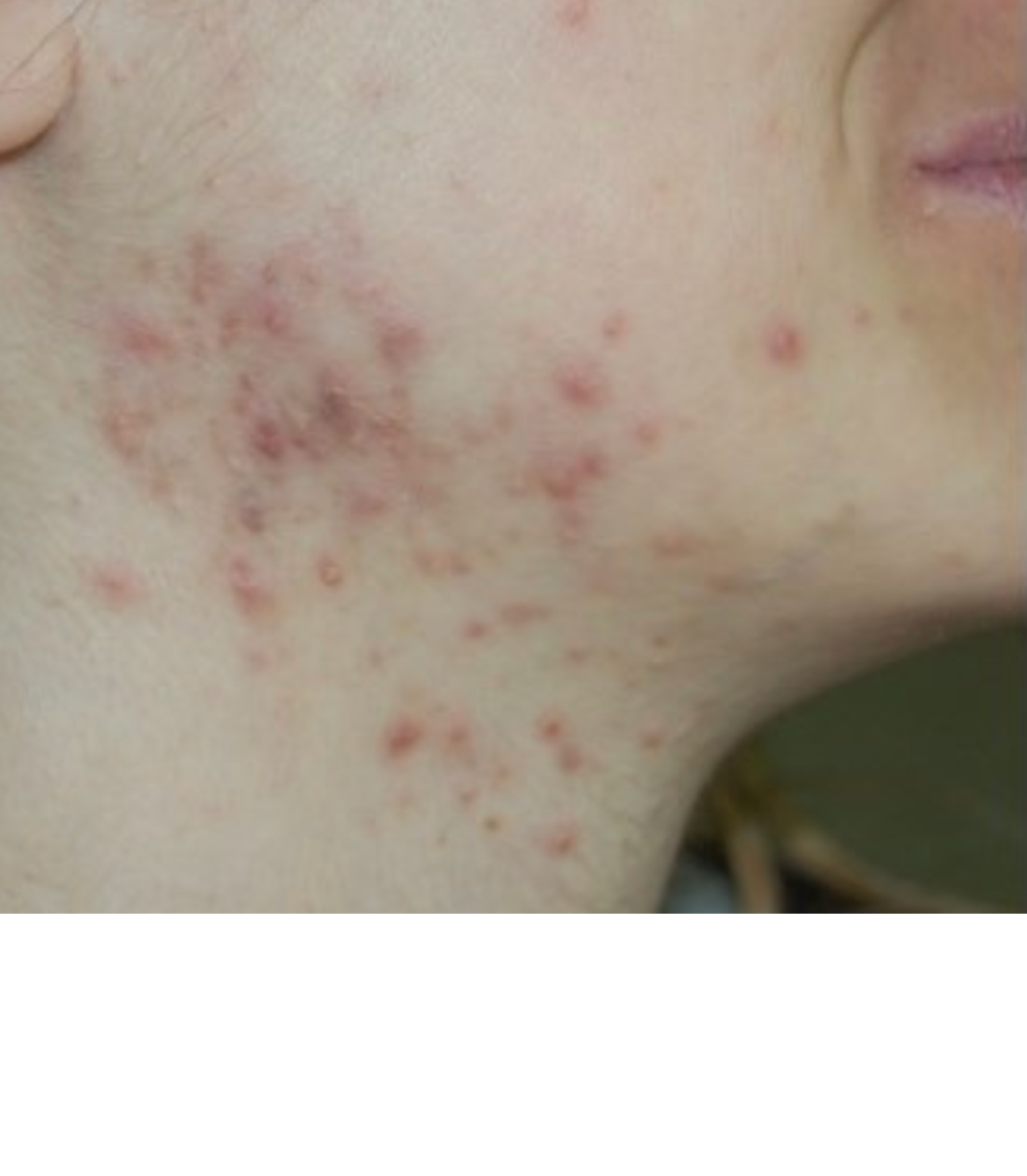 Kit Rutina Anti-Acne Avanzada
