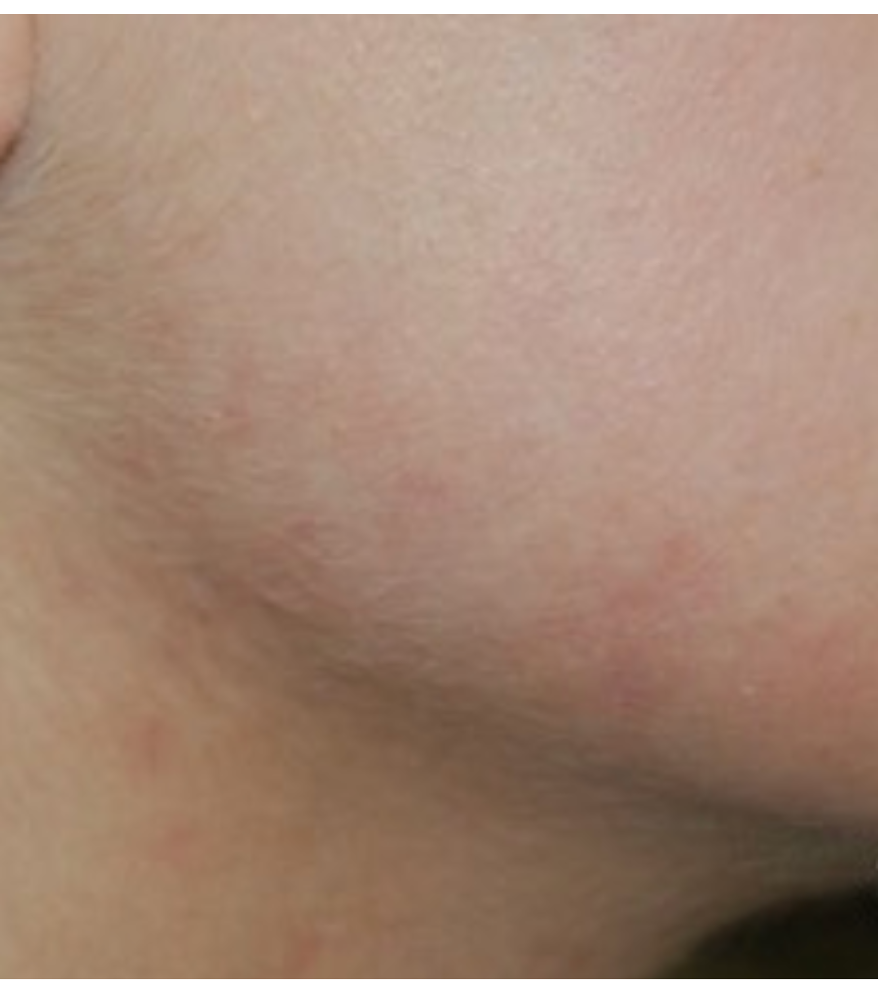 Kit Rutina Anti-Acne Avanzada