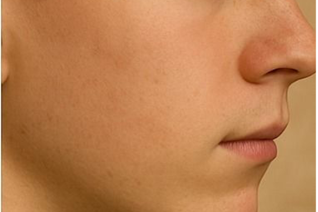 Corrector de Imperfecciones